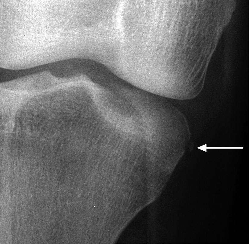 Imaging (not shown) also revealed a small focal fracture of the rim of the lateral tibial plateau.