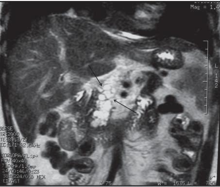 Macro- and microscopic examination revealed numerous cysts ranging from 2 to 12 mm in diameter with a thin translucent wall in the body and head of the pancreas. The tumor was 5 cm in diameter.