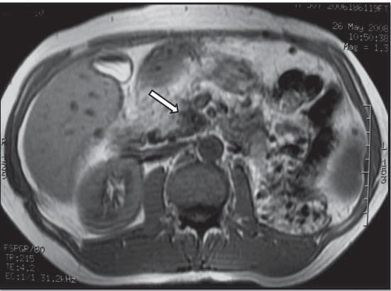 There was no discrete tumoral lesion, necrosis, calcification or hemorrhage observed on further examination of the pancreas (Fig. 1F). The duodenum was normal in appearance.