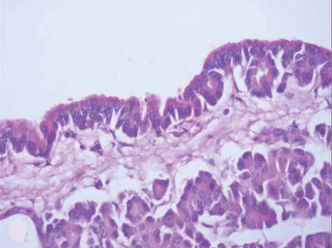 Acinar Cell Cystadenoma of Pancreas E F Fig. 1. Pancreas acinar cell cystadenoma in 52-year-old man. E. Image of macroscopic specimen.