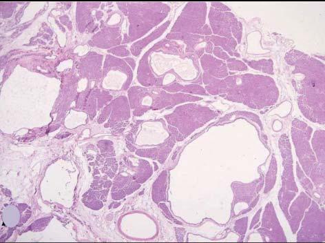 Eosinophilic secretion was demonstrated in some cystic structures. A foveolar metaplasia-like area was seen in a minute focus.