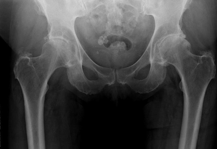 What is hip replacement?