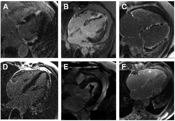 Advances in Cardiac MRI Sarcoidosis HCM SLE Slaughter
