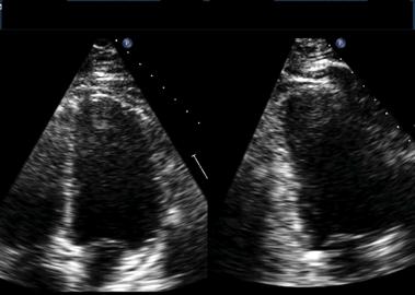 Advances in Echocardiography Contrast Increases quality and diagnostic accuracy of stress echo studies Reduces the number of
