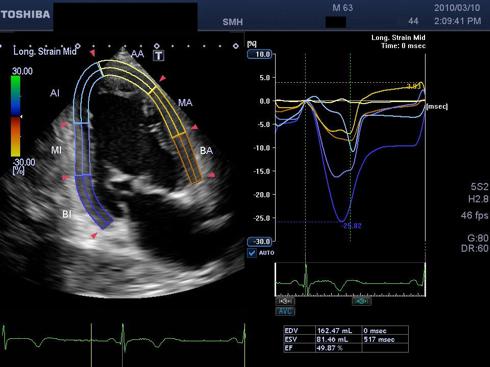 Advances in Echocardiography 2D Strain Imaging 2D Strain (speckle-tracking) is a measure of myocardial deformation More sensitive measure of systolic function and myocardial contractility