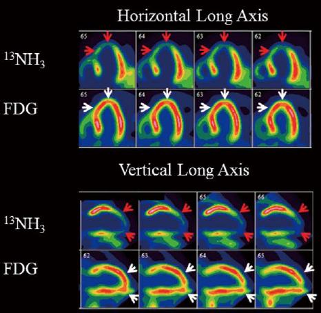 Advances in Nuclear Cardiology Positron Emission Tomography (PET) Alternative PET tracers to evaluate processes other than perfusion