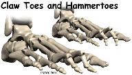 each toe that allow us to curl our toes, and one tendon runs along the top that raises the toe. Introduction Claw toe and hammertoe conditions are fairly common in cultures that wear shoes.