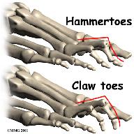 Moving down the foot from the metatarsal bone are three smaller bones, called phalanges. The first of these small bones is called the proximal phalanx. (Proximal means closer.