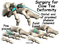 DIP Joint Arthroplasty For the hammertoe deformity, an arthroplasty of the DIP joint may be suggested. This procedure is performed through a small incision in the top of the toe over the DIP joint.