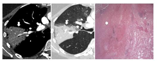 Clinical consequences of pulmonary embolism Infarction Small distal thrombi à ischemic necrosis
