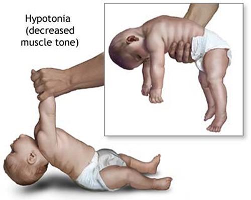 Identification of hypotonia Holding the infant in horizontal suspension The back hangs over the examiner's hand, and the limbs and head hang loosely Passive extension of