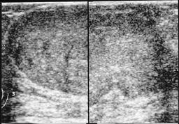 6 PPV:positive predictive value, NPV:negative predictive value, FPR:false positive rate, FNR:false negative rate. MM:Mammography, US:Ultrasonography, M I B I : 99 m Tc-MIBI scintimammography B A Fig.