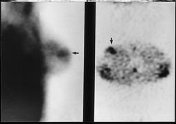 Mammogram reveals lobulated well-circumscribed isodense mass in upper outer quadrant of the right breast. This lesion was interpreted as probably benign finding(category 3). B.