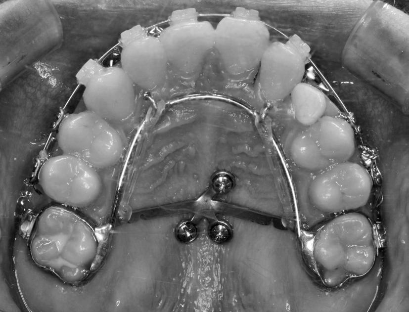 658 SA AED, PARK, BAYOME, PARK, KIM, KOOK Figure 1. The MPAP plced on the plte of ptient with lte mixed dentition.