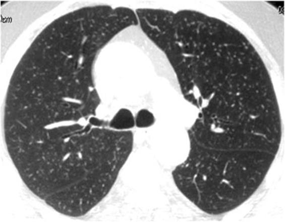 predominance Nodular perilymphatic Classic entity Sarcoidosis is typically characterised by a nodular pattern with perilymphatic distribution.