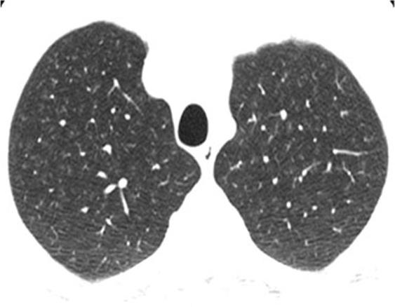 Classic entity The classic example for this pattern is subacute hypersensitivity pneumonitis, which commonly presents with this pattern as the predominant one (Fig. 31).