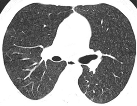 In case of LIP distinctive findings on HRCT may be the associated thickening of the interlobular septae, thin-walled lung cysts, areas of ground-glass opacity and slightly enlarged mediastinal