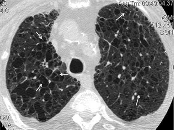 A drainage catheter is noted in the right pleural space in order to treat pneumothorax, which was the presenting symptom of this 27-year-old heavy smoker of the cysts may be uniform or varied in
