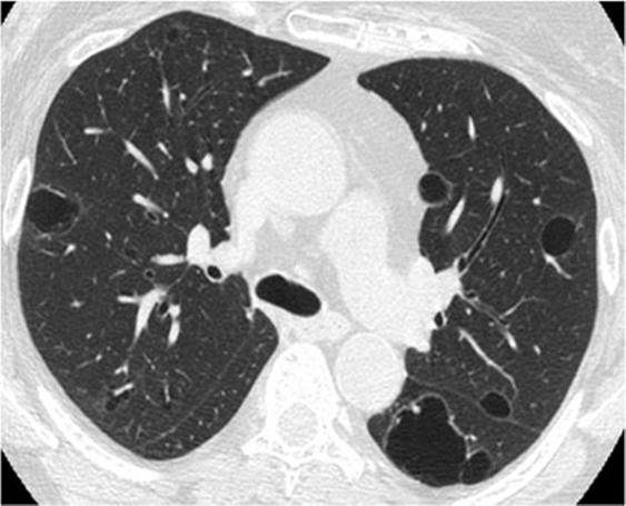 A classic entity presenting with cystic pattern is lymphangioleiomyomatosis (LAM), characterised by the presence of usually round, thin walled lung cysts which have no zonal predominance and are