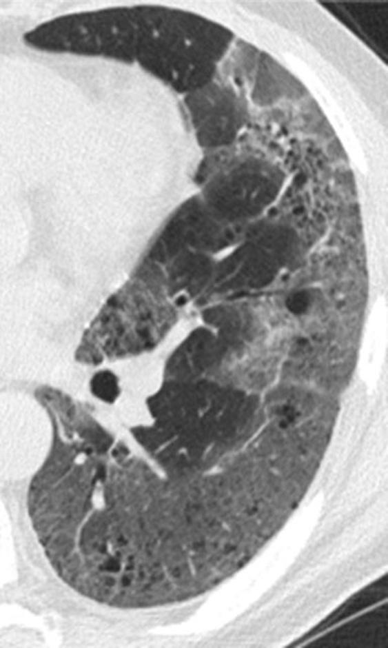 HRCT at the level of the lower lobes exhibits a decreased attenuation pattern characterised by patchy black areas with paucity of vessels and few scattered bronchiectasis Centrilobular emphysema,