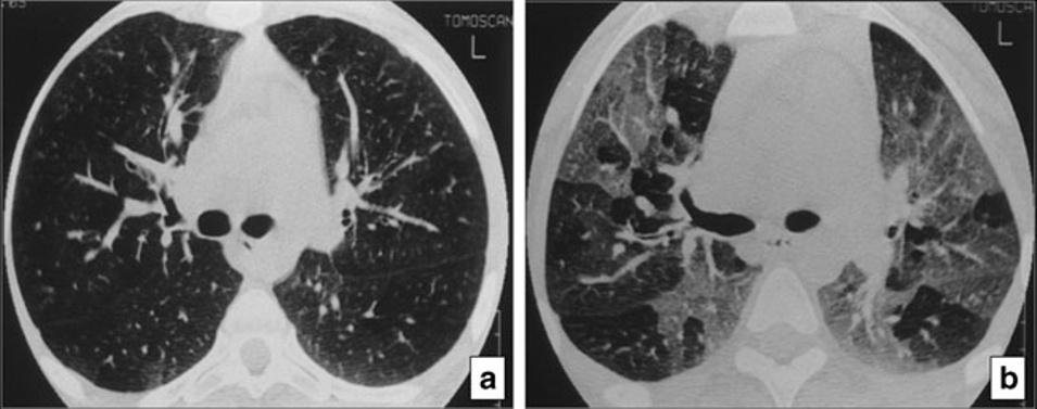 24 Insights Imaging (2013) 4:9 27 Fig. 44 Obliterative bronchiolitis in a patient with cystic fibrosis.