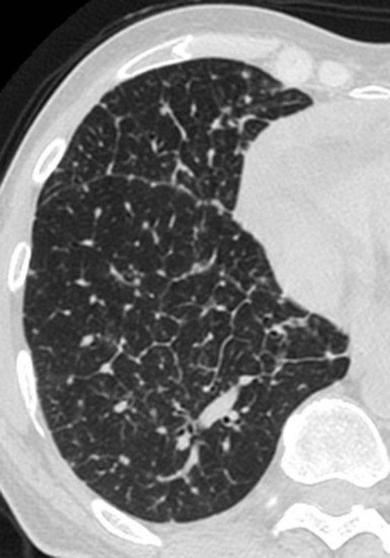 Right pleural effusion is also seen and extensive is a common finding.