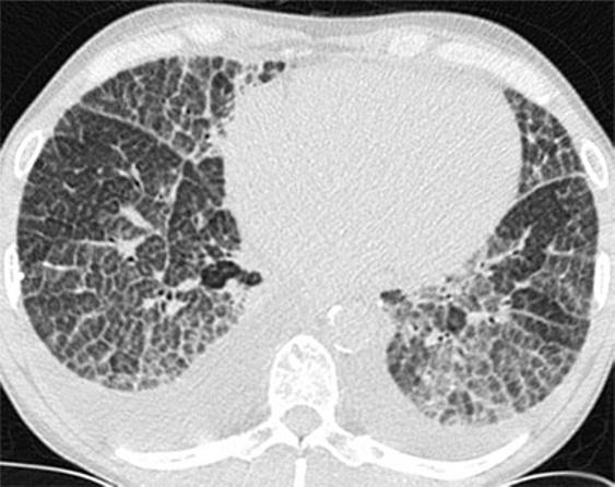 A calcified right paratracheal lymphnode is also noted the reticular pattern may be all or some of the following: interlobular septal thickening, intralobular interstitial thickening, wall cysts of