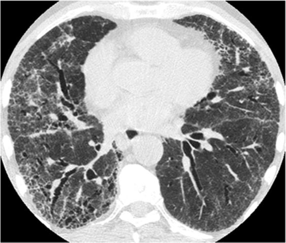 Classic entity The prototype entity for reticular pattern is idiopathic pulmonary fibrosis, which is characterised by subpleural and posterior predominance of intralobular interstitial thickening,