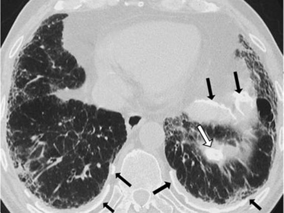 Insights Imaging (2013) 4:9 27 13 diffuse pleural thickening, subpleural lines or parenchymal bands [17] (Fig.7).