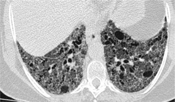 It is characterised by the presence of traction bronchiectasis and bronchiolectasis and minimal honeycombing. Areas of ground-glass opacity and hazy centrilobular micronodules may coexist.