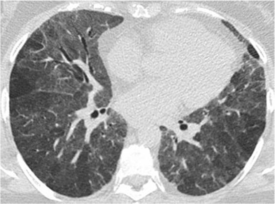 centrilobular nodules. The above findings may be diffuse throughout the lungs or predominate in the middle and lower lung zones.