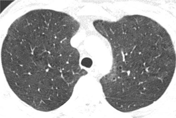 expiratory images [18] (Fig. 12). Another clue form the clinical history is the absence of smoking since HP is much less common in smokers [21].