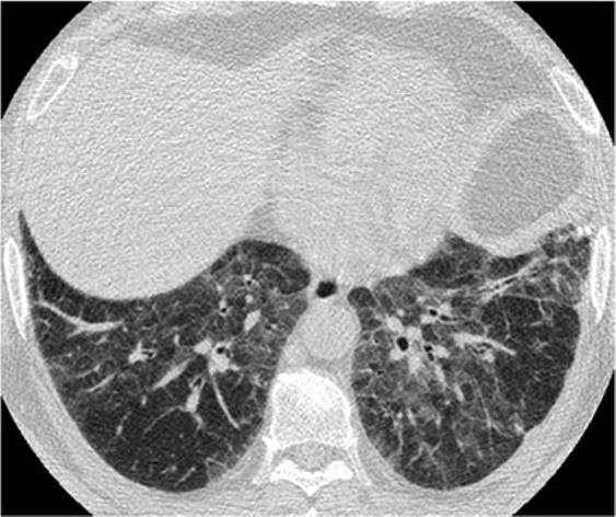 Note the characteristic 5 mm subpleural sparing, which is characteristic for NSIP the most common histological type of scleroderma associated pulmonary fibrosis Idiopathic pulmonary fibrosis (IPF)