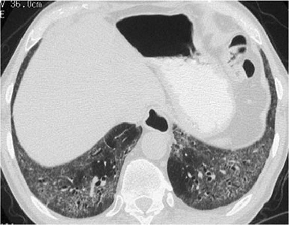 Although pure desquamative interstitial pneumonia (DIP) is a rare entity, its most common pattern is that of ground-glass opacity associated with mild reticulation, which may mimic NSIP [20, 36] In