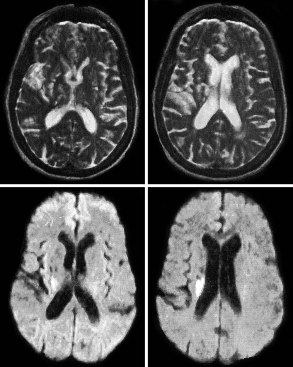 A B C D Figure 1. A 63-year-old woman with sudden onset left-sided pure motor hemiparesis underwent magnetic resonance imaging 11 hours after symptom onset.