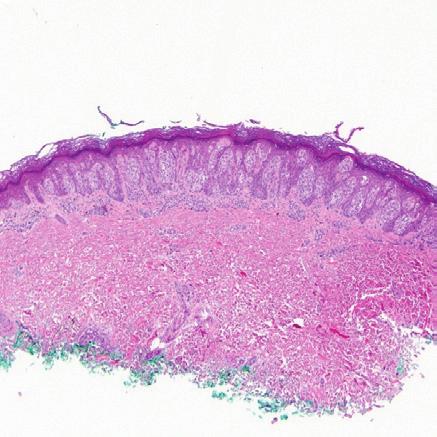 Olsen, Patel, Ma & Fullen Classic Spitz nevus & variants Classic Spitz nevus Spitzoid lesions are composed of varying proportions of spindled and epithelioid cells that display a characteristic