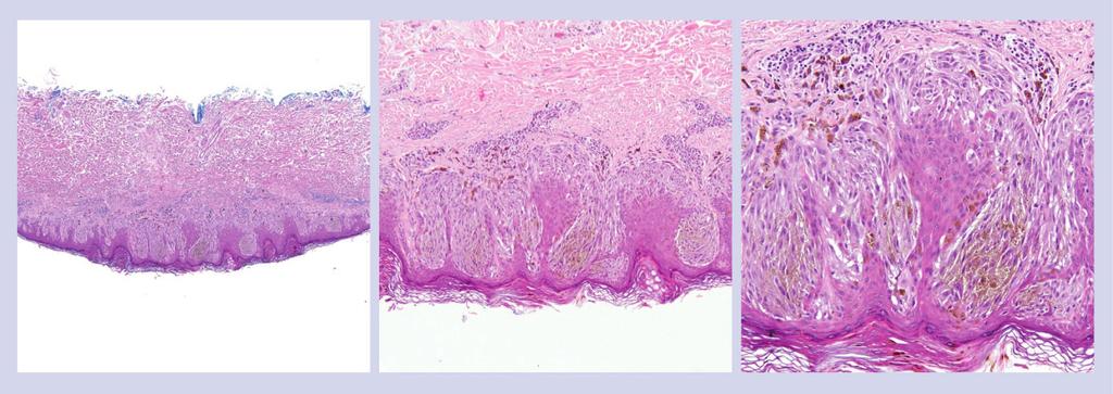 Difficulties in the diagnosis of spitzoid melanocytic lesions and circumscription, lack of a significant junctional component in most cases, more uniform cytomorph ology of the spitzoid cells, and