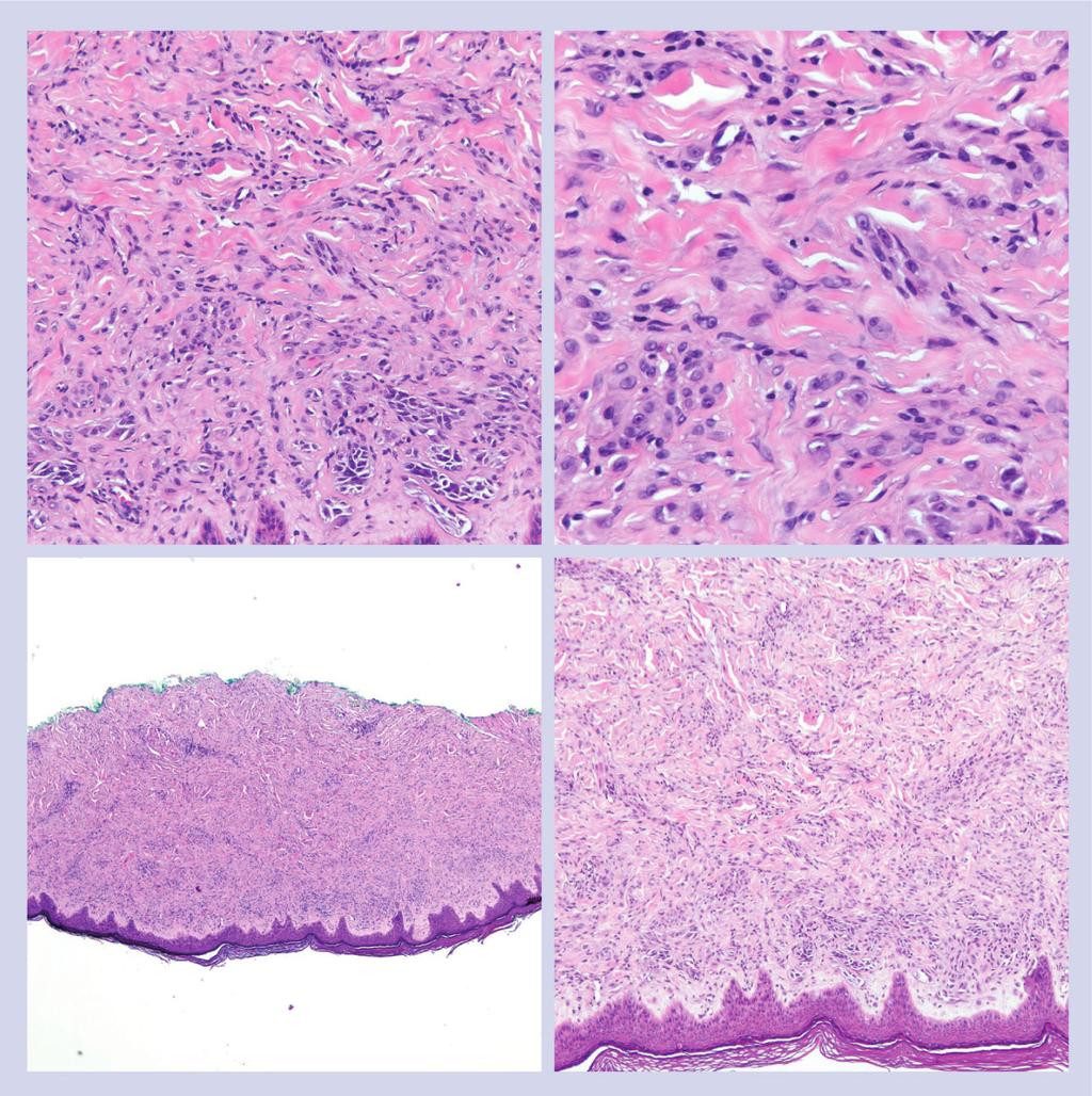 Vascular and fibro h istiocytic lesions can be differentiated from angiomatoid Spitz nevus by evaluation of appropriate immunohistochemical stains. Figure 2. Pigmented spindle cell nevus.