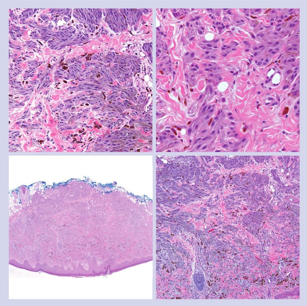 Olsen, Patel, Ma & Fullen useful than a Ki-67 index in inflamed spitzoid lesions [17]. We have found HMB-45 and Ki-67 immunohistochemistry helpful in a subset of cases.