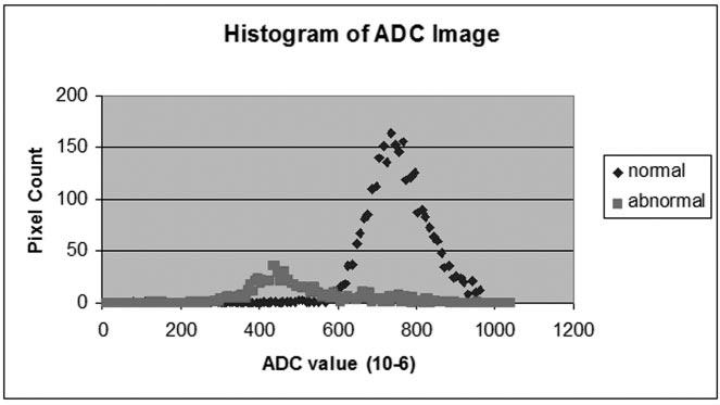 AJNR: 25, August 2004 CT PERFUSION PARAMETERS 1207 FIG 1. Histogram of ADC values in both normal contralateral brain and a region of interest including infarct (abnormal). FIG 2.