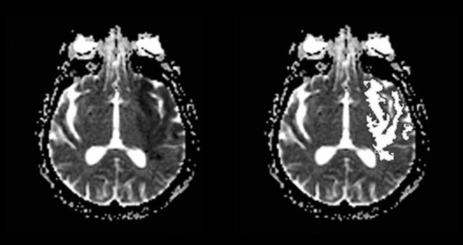 1208 GALVEZ AJNR: 25, August 2004 FIG 3. Images with decreased signal intensity and the region with 30% decrease compared with normal brain parenchyma. Left, ADC images (b 0 s/mm 2 ).