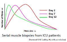 Measures of muscle wasting in critical illness Conchotome biopsy Conchotome biopsy,