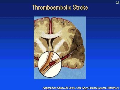 Stroke as a result of A Fib Signs and Symptoms Loss of sensation on one side of the body