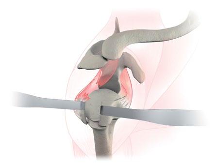 The anterior and middle deltoid muscles are separated with respect to the lateral edge of the acromion.