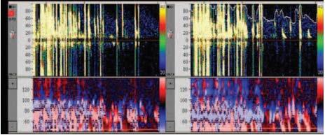 Bilateral multifrequency transcranial Doppler monitoring of