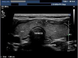 The experiment is done to test the software. The experiment involves five thyroid ultrasound images. The result is saved and analyzed.