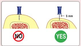5. Check that the 5mm mark is visible above the skin to confirm that you have correct size of needle for your patient 6. There is a slight give as the marrow cavity is entered 7.