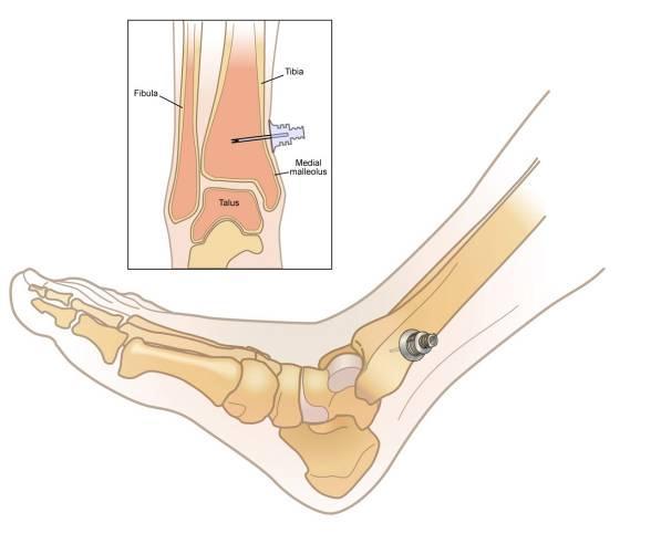 Insert proximal to the medial malleolus as shown below Midline of bone Securing the EZ-IO Device