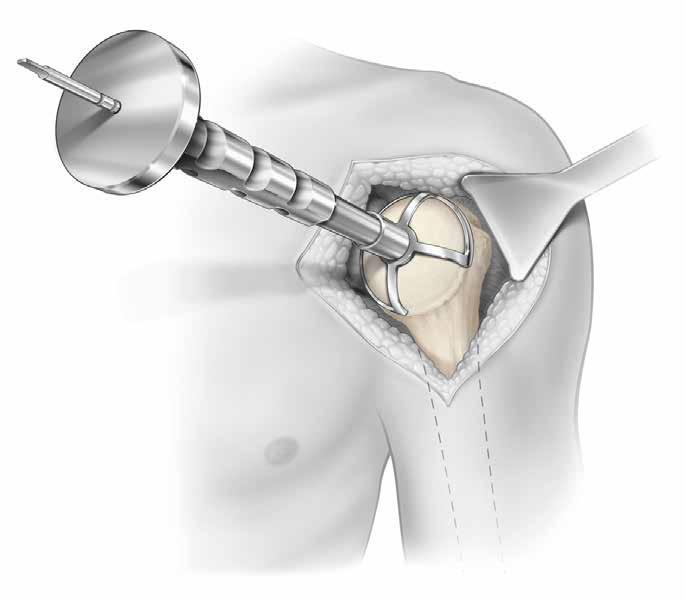 Once this flap is completely developed, the humeral head is then delivered through the capsulotomy underneath the subscapularis (Figure 5).