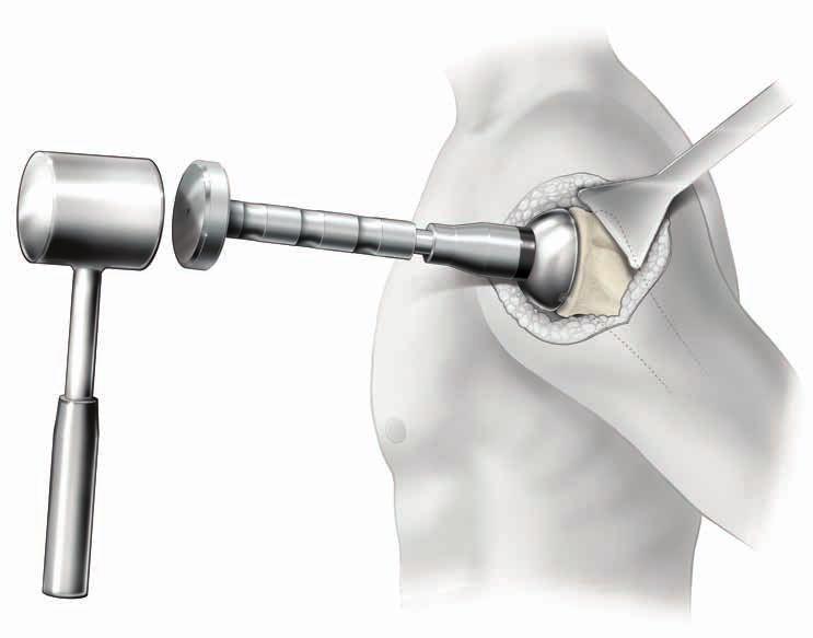Care should be taken to leave a gap of approximately 1mm between the inferior reamed surface of the humerus and the bottom rim of the Resurfacing Humeral Head to prevent stress shielding.